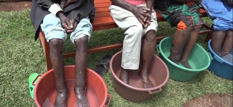 Nyamasheke : Amashimwe y'abarwayi b'imidido bavuwe bagakira