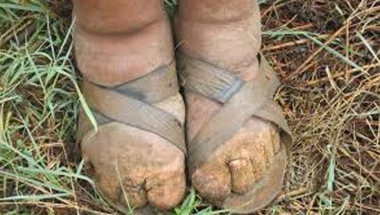 Abarenga 6 000 barwaye imidido