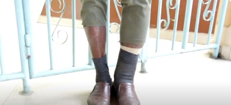 Musanze–Burera: kuvura gusa abafite indwara y’imidido ntibihagije