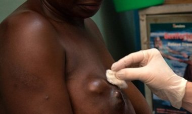 Ibimenyetso mpuruza bya kanseri y'ibere ku bagabo