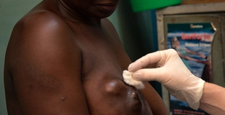 Ibimenyetso mpuruza bya kanseri y'ibere ku bagabo