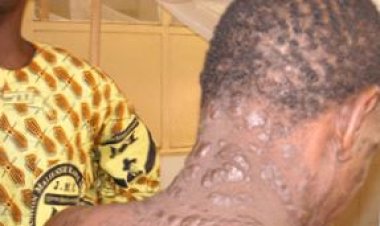 U Rwanda rwafashe ingamba zo kurwanya indwara y’ibibembe