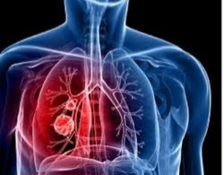 Abavuzi gakondo n’amavuriro mu rugamba rwo kurwanya igituntu