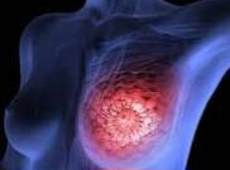 Menya kanseri 10 zibasiye Abanyarwanda